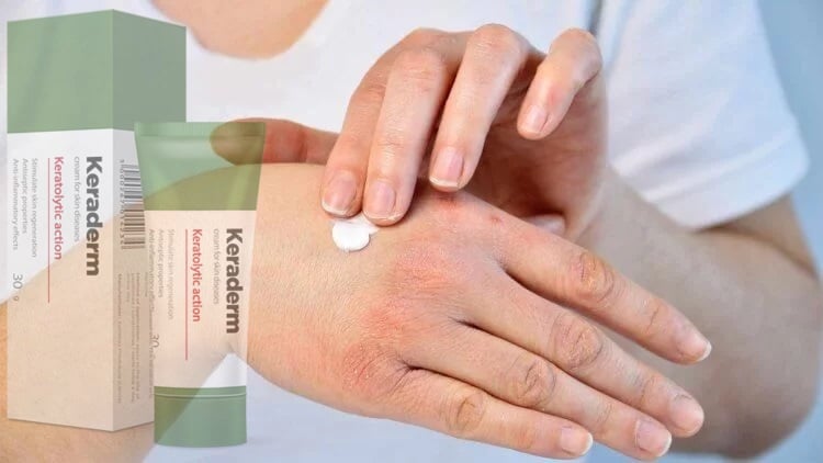 Keraderm természetes krém pikkelysömör tünetei – Teljes elemzés